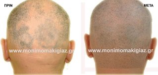 scalp